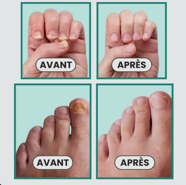 Sérum Anti-Mycose des Ongles 7Jours — Traitement Naturel Ongles Mains & Pieds